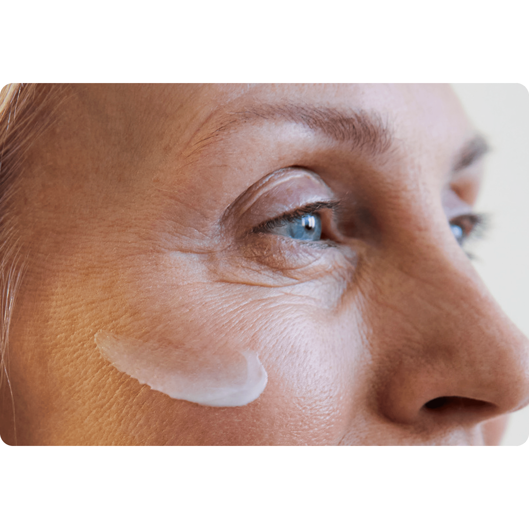 Líneas de Expresión en los Ojos